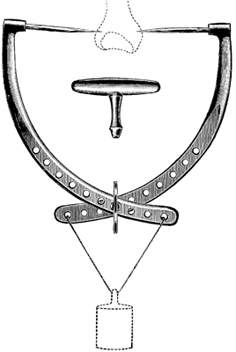 FACTOR & EXTENSION BOWS
